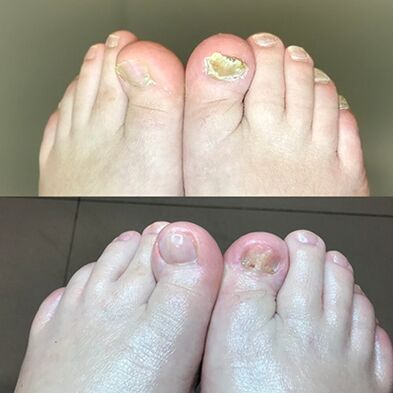 Erfahrung in der Verwendung von Promiccreme -Barnabas aus Israel, Foto vor und nachher