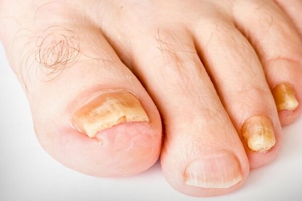 Die dritte Stufe der Nagelhirb