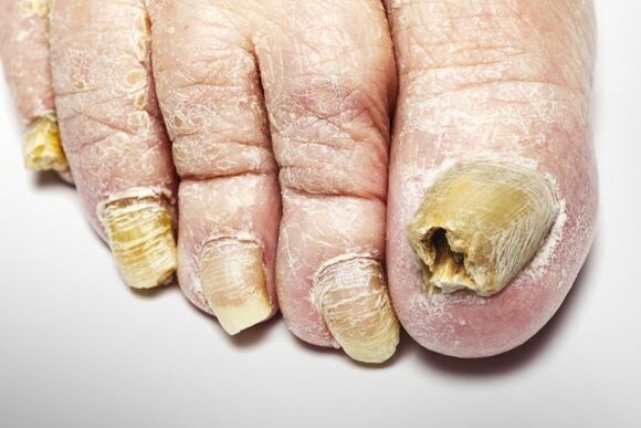Gesamtversion des Nagelpilzes
