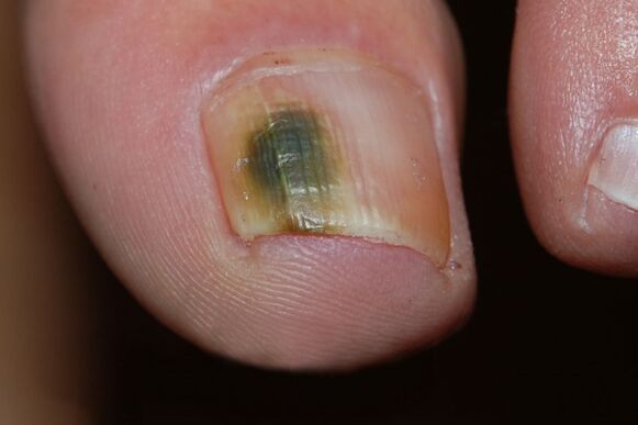 schimmelige Art von Nagelpilz