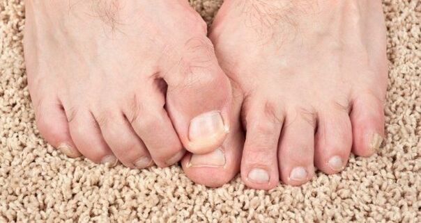 Symptome von Nagelpilz