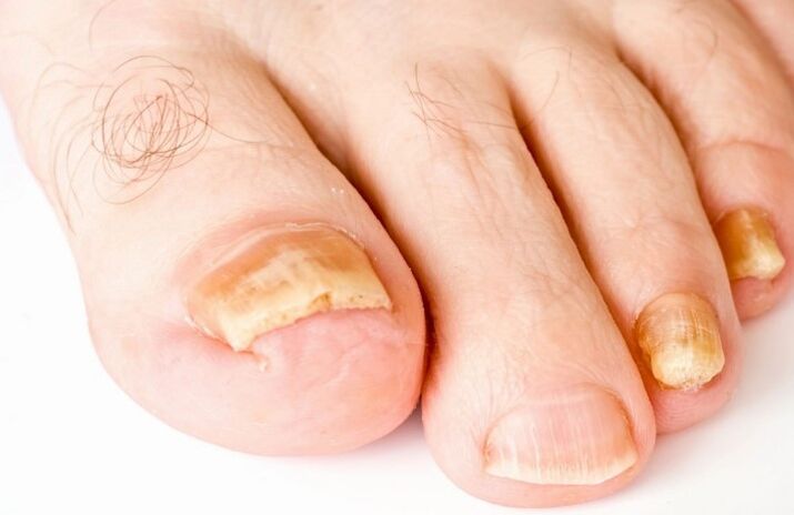 Der Pilz am Daumen des Beins