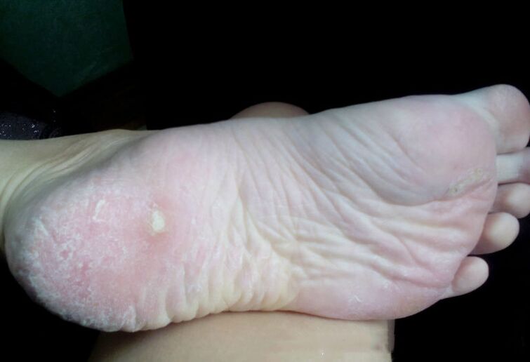 Behandlung des Pilzes mit einem Laser