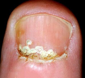 Symptome und Anzeichen der Krankheit