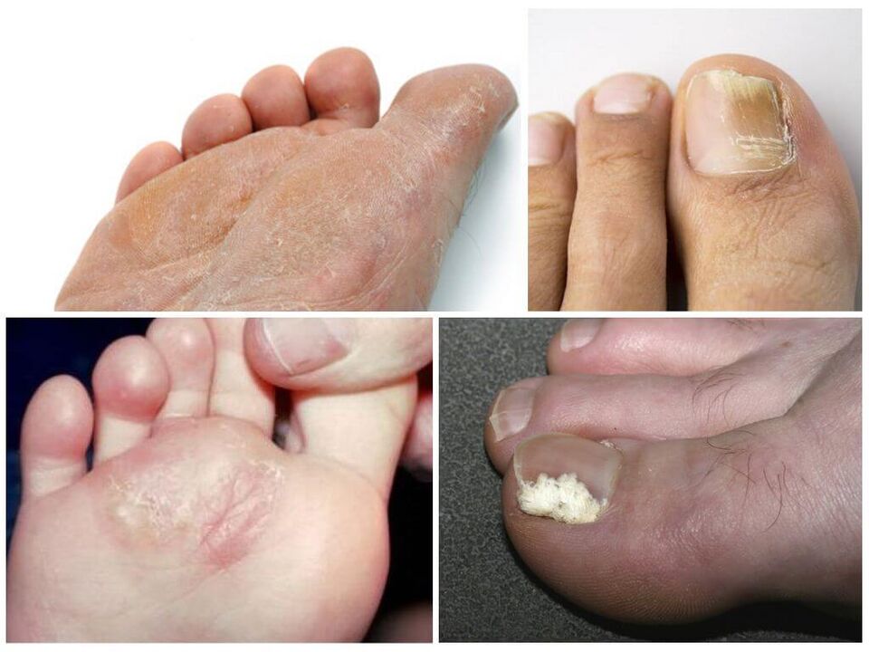 Das Anfangsstadium von Fußpilz