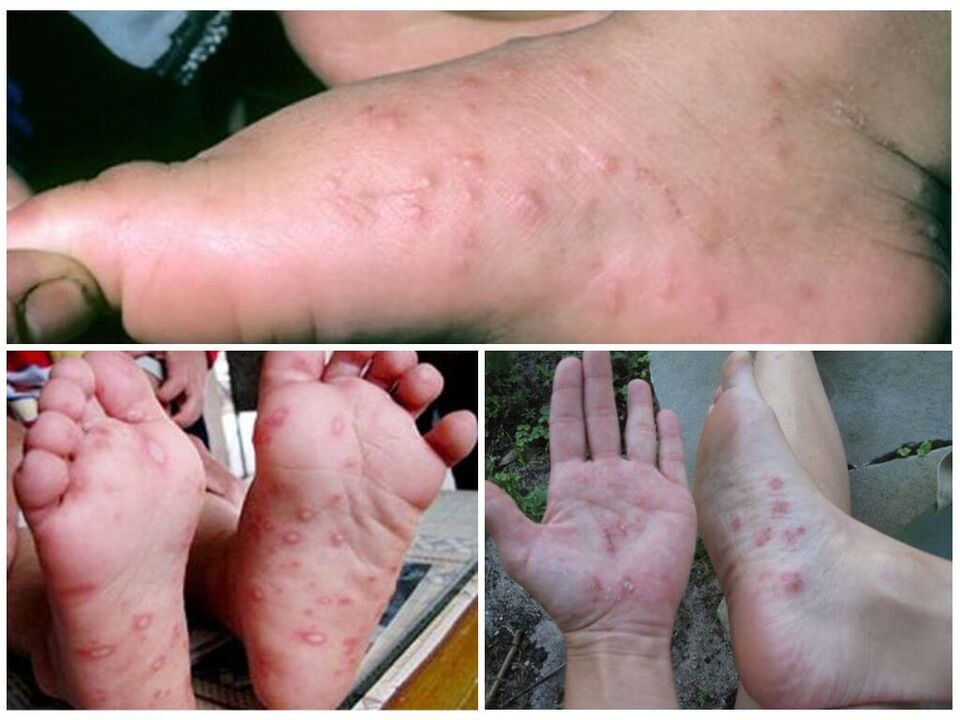 Hyperkeratotische Läsionen der Füße