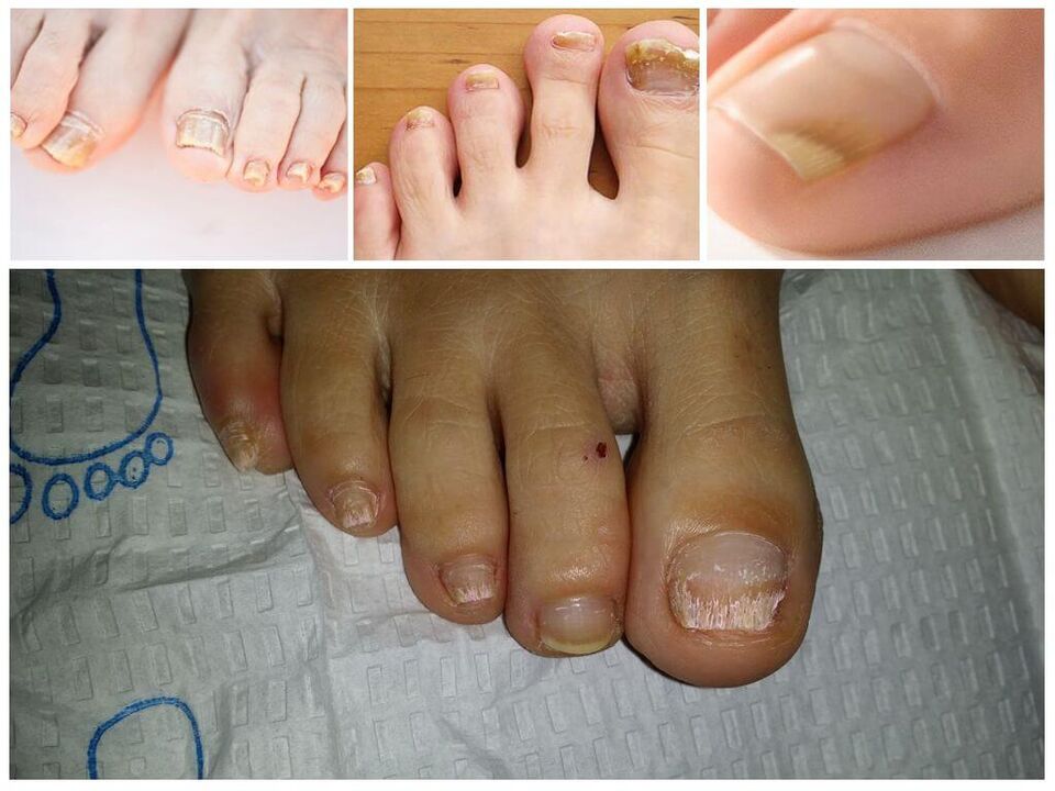 Pilzerkrankungen der Nagelplatten