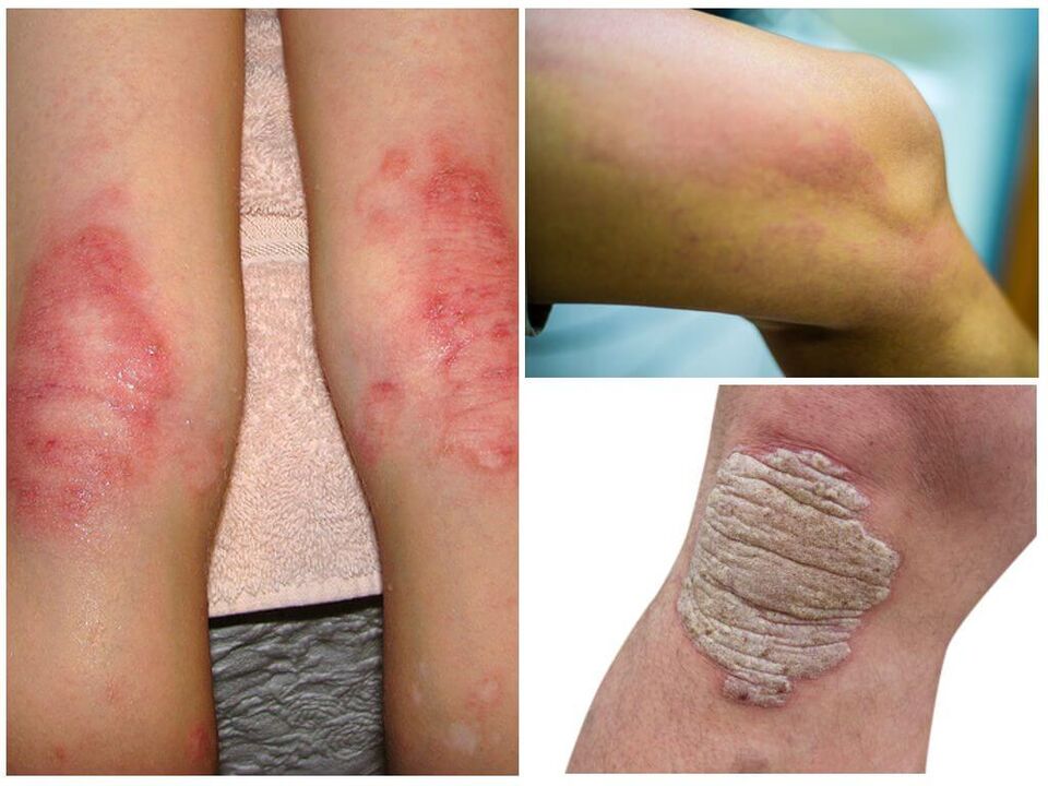 Pilzinfektionen der Knie