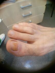 Anfangsstadium eines Nagelpilzes an der großen Zehe