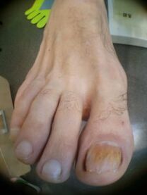 Nagelpilz an der großen Zehe