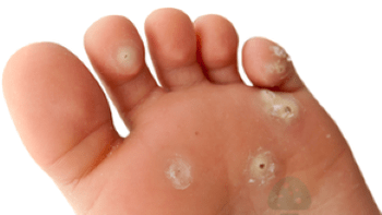 zweites Stadium einer Pilzinfektion