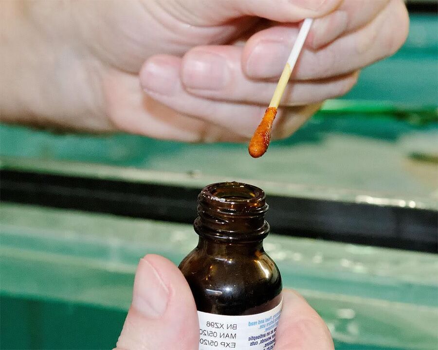 Durch Auftragen einer Mischung aus Jod und Schöllkrautsaft auf die Zehennägel wird der Pilz beseitigt
